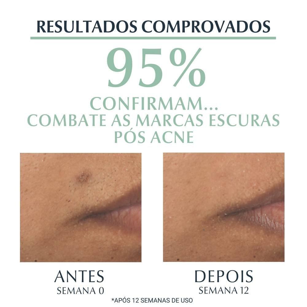 Sérum Facial Antiacne Eucerin Dermo Pure Efeito Triplo 40ml - 4