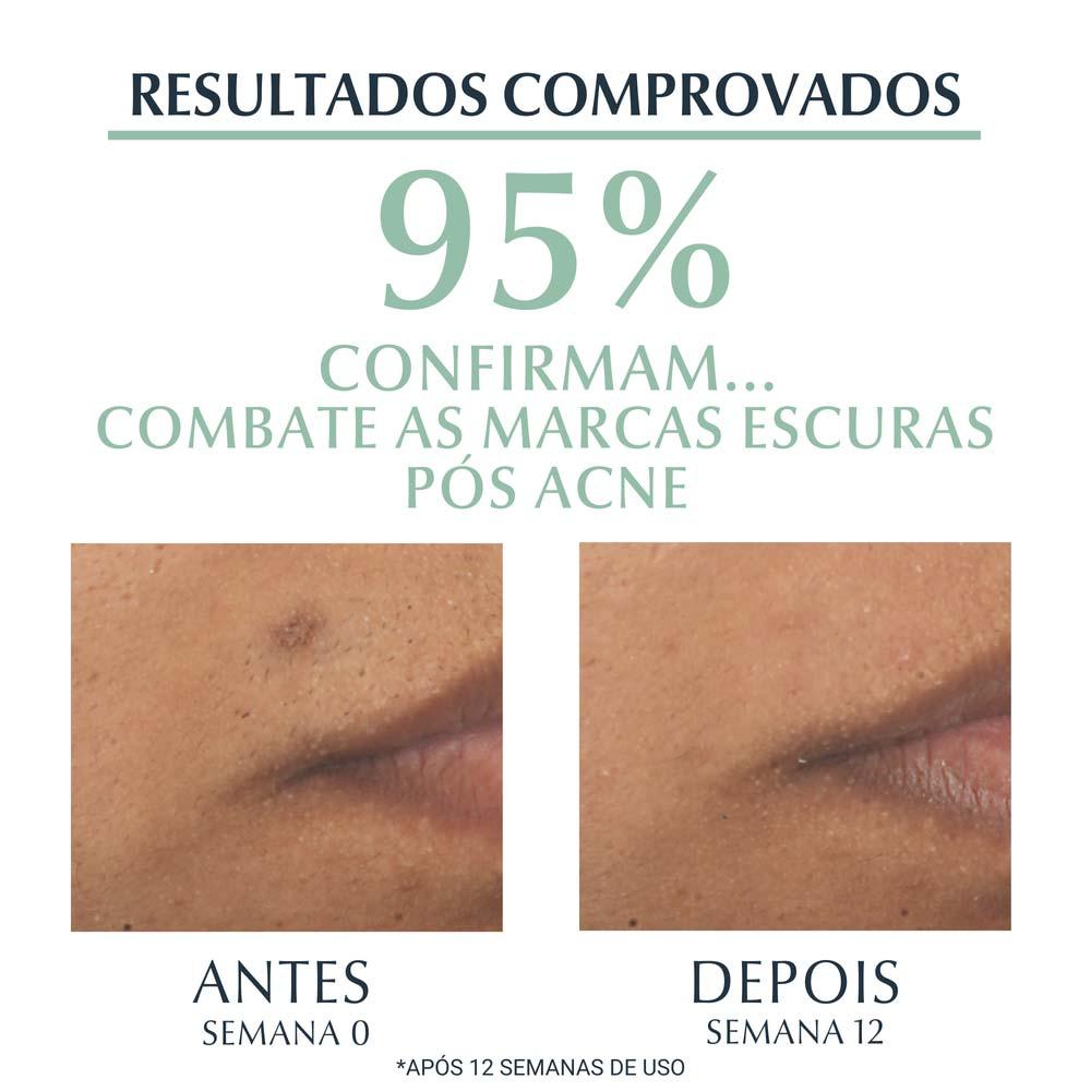 Sérum Efeito Triplo Eucerin – DermoPure Oil Control - 6