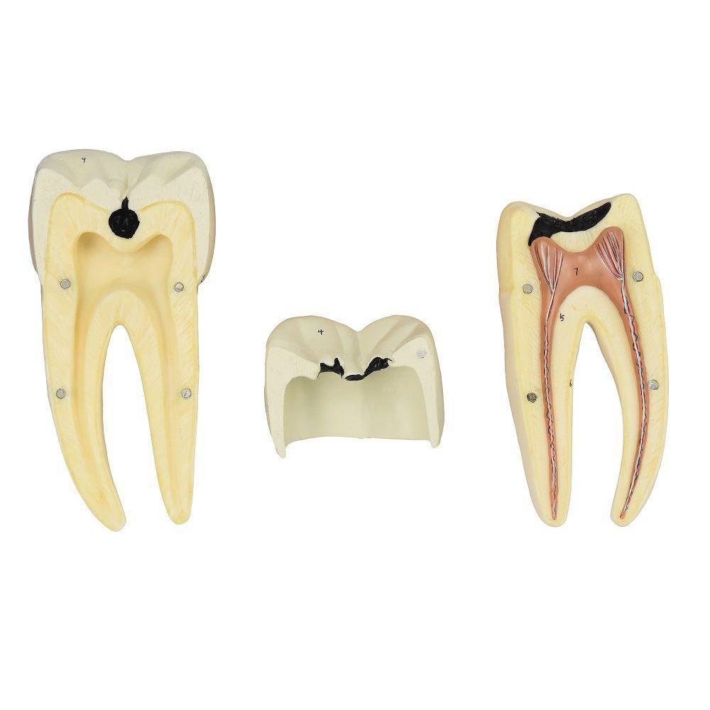 Dente Molar Inferior C/ Raiz Dupla Em 3 Partes C/ Cárie, 8x - 2