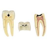 Dente Molar Inferior C/ Raiz Dupla Em 3 Partes C/ Cárie, 8x - 2