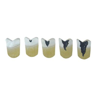 Dente Molar Ampliado Evolução Da Cárie Em 8 Parte