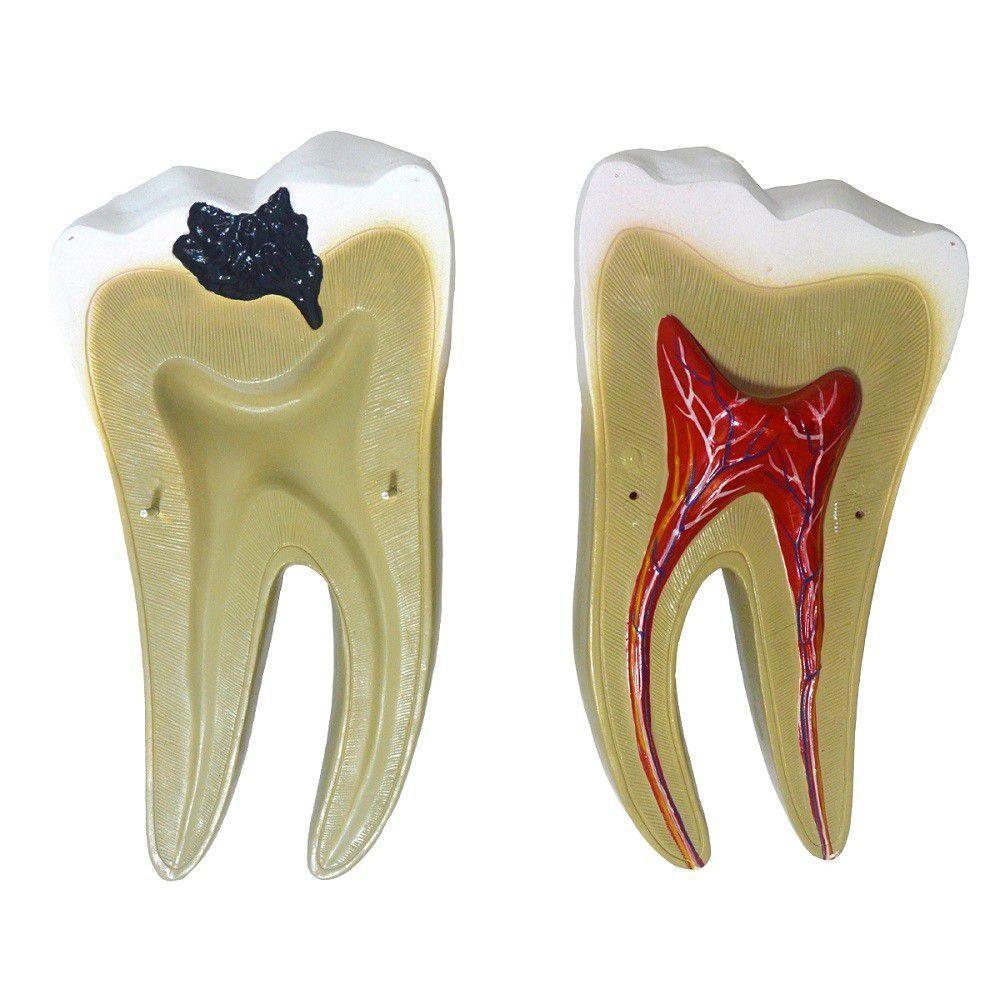 Dente Molar Ampliado Saudável E Cárie Modelo Anatomia - 3