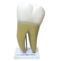 Dente Molar Ampliado Saudável E Cárie Modelo Anatomia - 2
