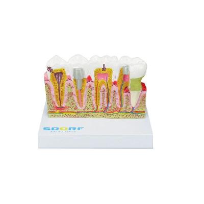 Modelo de Patologias Dentárias SD-5202