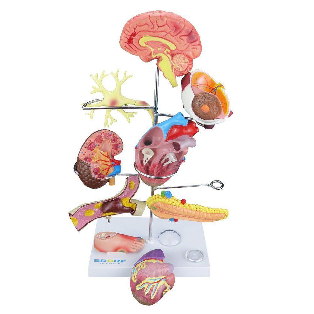 Modelo de Órgãos Afetados pela Diabetes em 11 Partes SD-5213 - 1