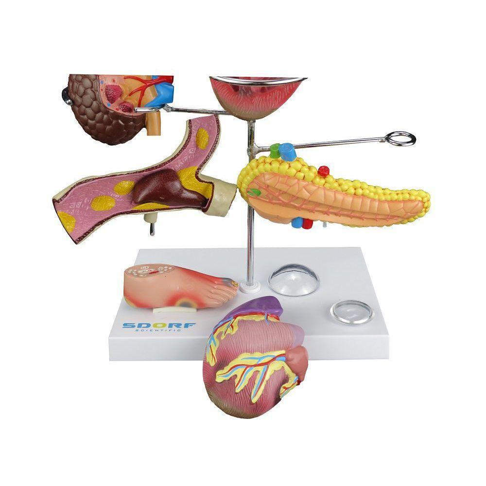 Modelo de Órgãos Afetados pela Diabetes em 11 Partes SD-5213 - 2
