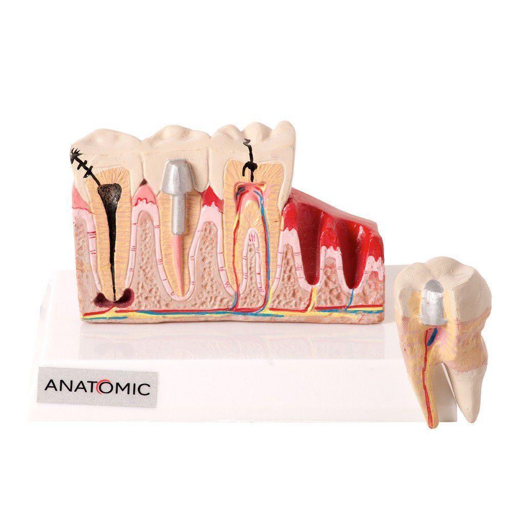 Patologia Dentária e Placa Explicativa em 2 Partes Modelo - 2