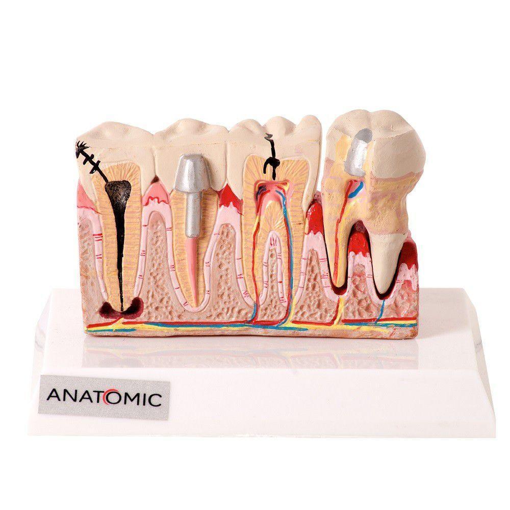 Patologia Dentária e Placa Explicativa em 2 Partes Modelo - 3