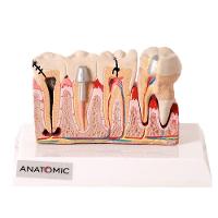 Patologia Dentária e Placa Explicativa em 2 Partes Modelo - 3