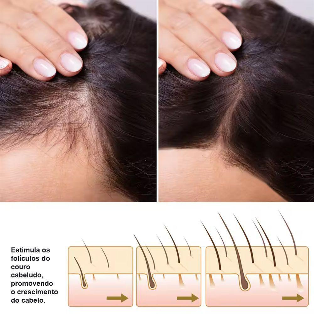 Essência Capilar Lanbena Hair Growth 20ml Spray Para Cabelo Barba E Contra Queda - 4