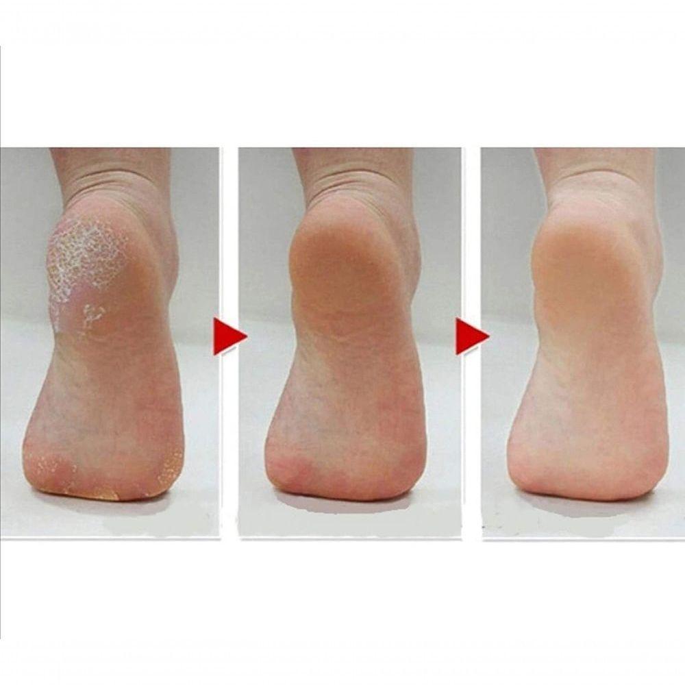 Removedor De Calos Lixa Elétrica Pés Pedicure Calosidade Portátil - 3