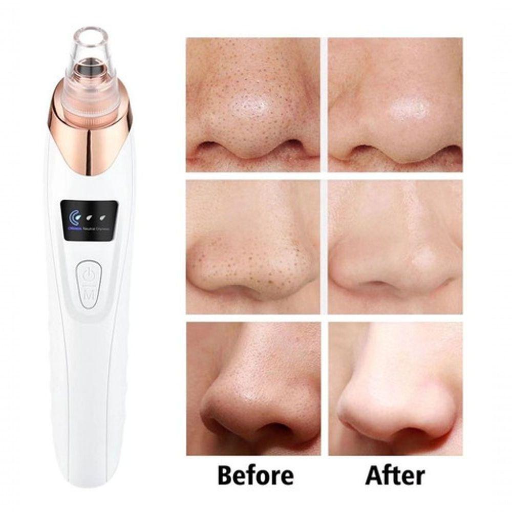 Aparelho Removedor De Cravos E Espinhas Elétrico - 3